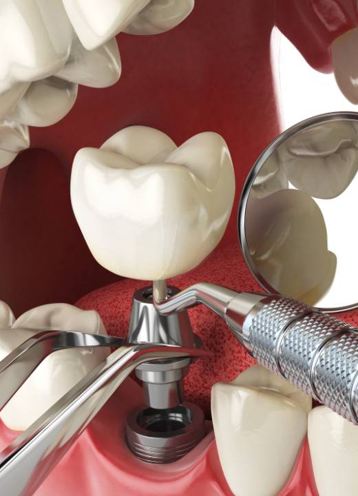  Tijuana Dental Prices